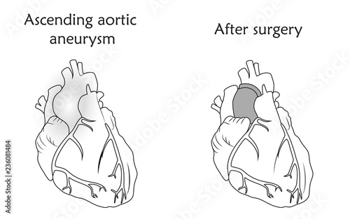 Ascending aortic aneurysm before and after repair. Tube graft and damaged heart muscle. Anatomy flat illustration. Outline image, white background.