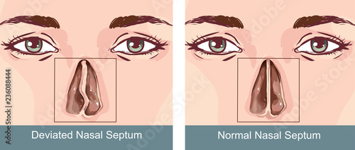 Nasal Septum Deviation Treatmen
