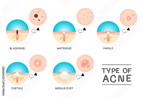 Type Of Acne 