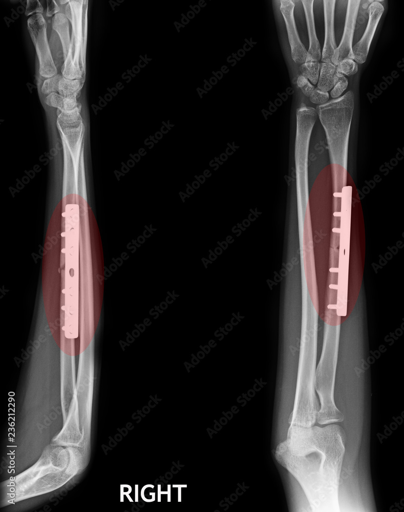 fracture shaft of radius & ulnar bone, x-ray film Stock Photo | Adobe Stock