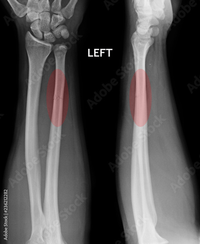 fracture shaft of radius & ulnar bone, x-ray film