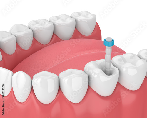 3d render of jaw with teeth and fiber post