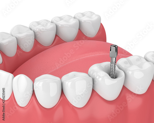 3d render of jaw with teeth and dental metal post