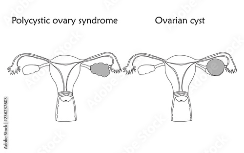 Polycystic ovary syndrome and ovarian cyst. Human realistic uterus. Anatomy flat illustration. Thin line image, white background. Gynecological diseases.