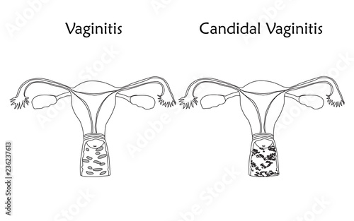Vaginitis and candidal vaginitis. Human realistic uterus. Anatomy flat illustration. Thin line image, white background. Gynecological diseases.