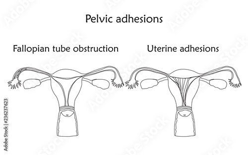 Pelvic adhersions. Uterine adhesions and fallopian tube obstruction. Human realistic uterus. Anatomy flat illustration. Thin line image, white background. Gynecological diseases..