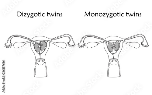 Multiple pregnancy. Dizygotic and monozygotic twins, embryo, fetus in uterus, placenta, umbilical cord. Vector flat medical illustration. Thin line image, white background.