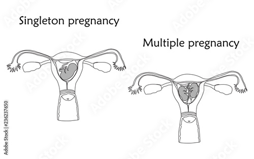 Multiple and singleton pregnancy, twins, embryo, fetus in uterus, placenta, umbilical cord. Vector flat medical illustration. Thin line image, white background.