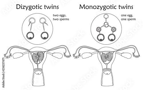 Multiple pregnancy. Dizygotic and monozygotic twins, embryo, fetus in uterus, placenta, umbilical cord, egg, sperm. Vector flat medical illustration. Thin line image, white background.