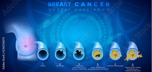 Breast cancer Ductal cancer stages background. Ductal carcinoma of the breast, detailed medical illustration. Ductal cancer in situ and invasive ductal cancer cross section anatomy.