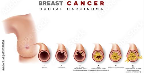 Breast cancer Ductal carcinoma of the breast. Normal duct, then hyperplasia, after that atypical cells are invading, Ductal cancer in situ and invasive ductal cancer.