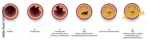 Breast cancer Ductal carcinoma of the breast. At the beginning normal duct, then hyperplasia, after that atypical cells are invading, Ductal cancer in situ and invasive ductal cancer with metastases