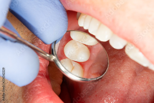 two chewing side teeth of the upper jaw after treatment of caries. Restoration of the chewing surface with a photopolymer filling material using the Rubber Dam system photo