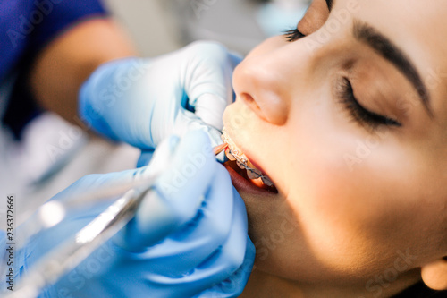 Dentist putting braces on the patient s teeth close-up in a dental clinic