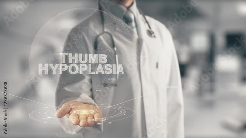 Doctor holding in hand Thumb hypoplasia photo