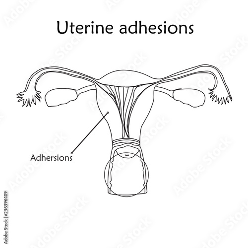 Uterine adhesions. Human realistic uterus. Anatomy flat illustration with specification. Thin line image, white background. Gynecological diseases.