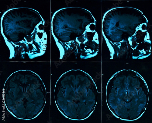 Magnetic resonance scan of the brain with skull. MRI head scan on dark background blue color. X-ray medicine and medication concept