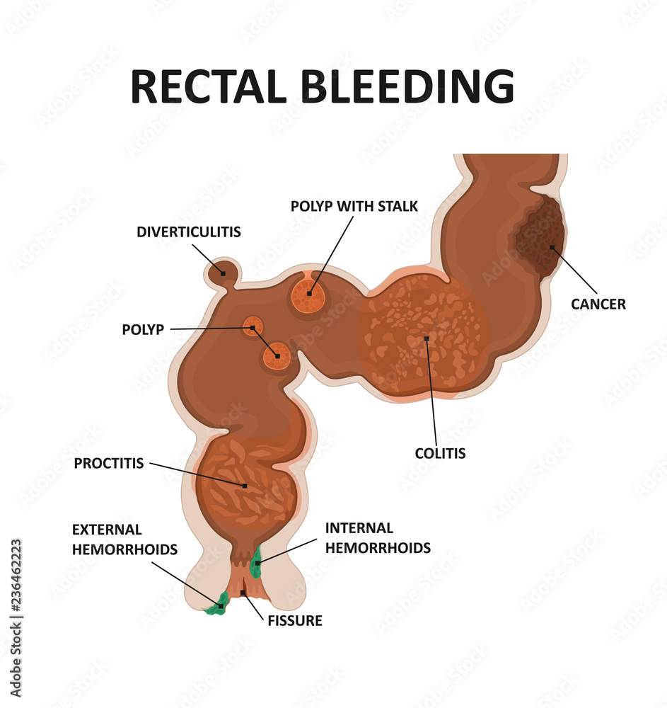 Cause rectal bleeding. Stock Vector Adobe Stock