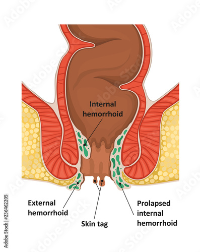 Types of hemorrhoids. photo