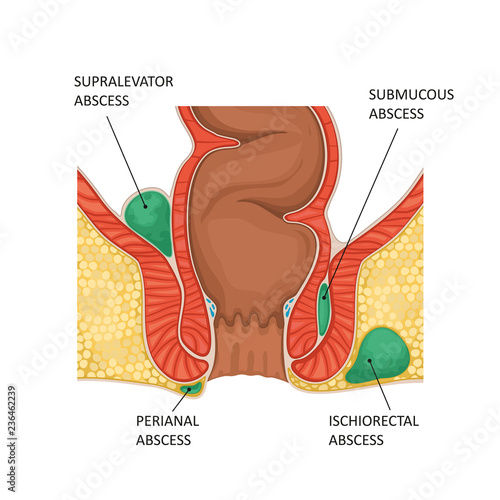 Anal abscess. Vector illustration