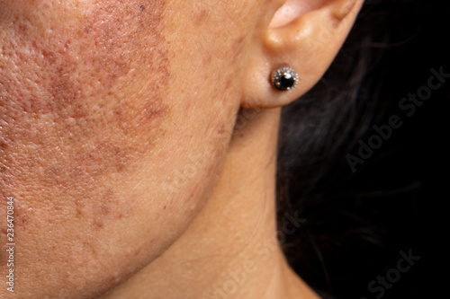Age spots and increased skin pigmentation photo