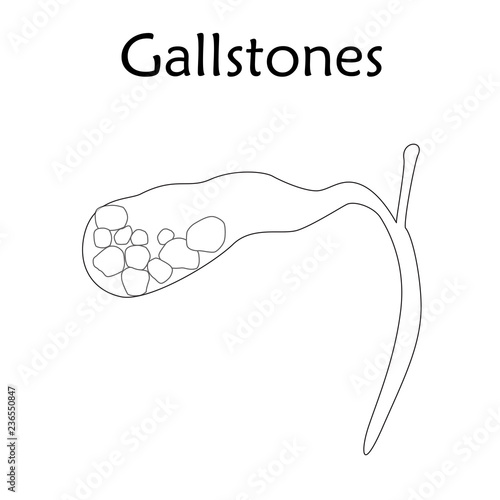 Gallbladder disease, inflammation. Gallstones. Cholecystitis. Anatomy vector flat illustration. White background. Thin line design.