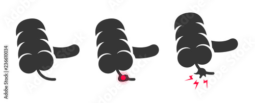 appendicitis human intestine / organ , anatomy