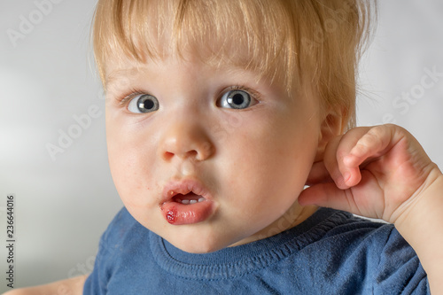 Close-up of baby bruised injured lip after falling. Children traumas concept