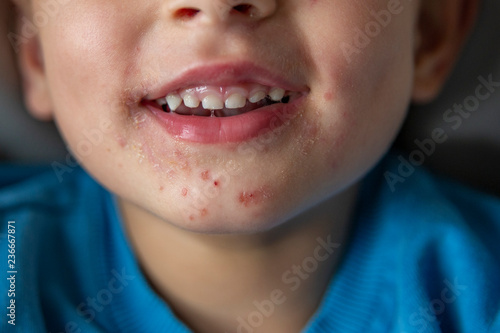 Hand, foot, and mouth disease (HFMD). Typical lesions around the mouth photo