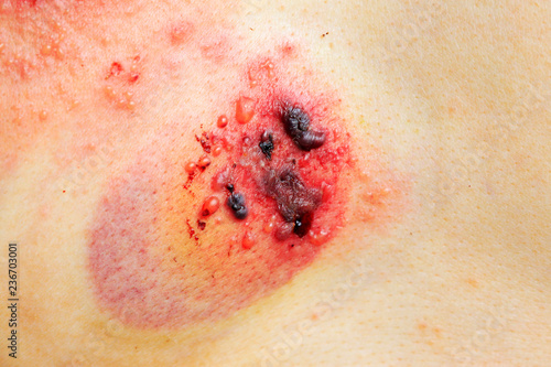 Skin disease - multiple herpes