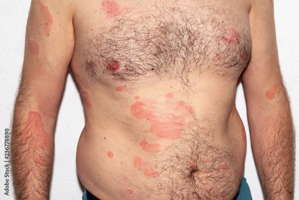 Allergy. Reaction. Intolerance. Histamine. Health Allergy. Reaction. Intolerance. Histamine. Health