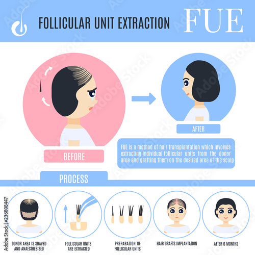 FUE female alopecia treatment medical poster in cartoon style