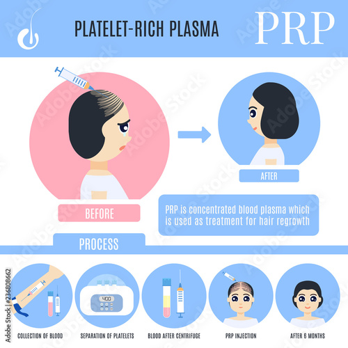 PRP female alopecia treatment medical poster in cartoon style