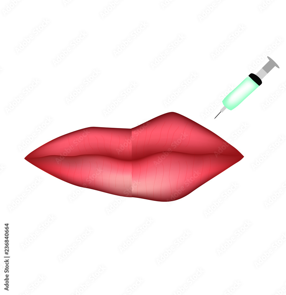 Injections for lip augmentation. Botox. Lips before and after cosmetic