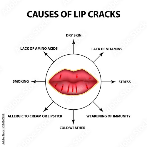 Causes of lip cracks. Cracks in the corners of the mouth. Infographics. Vector illustration on isolated background.