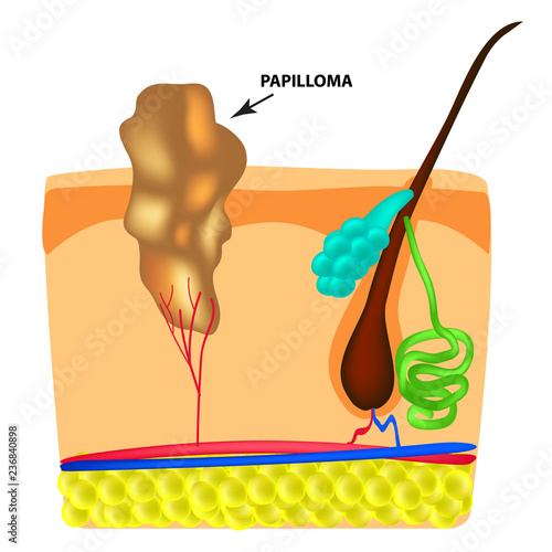 The structure of the papilloma. The structure of the skin. Infographics. Vector illustration on isolated background.