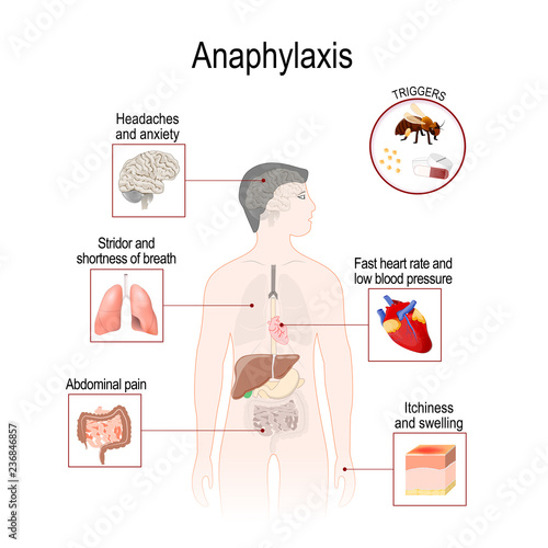 Anaphylaxis is a serious allergic reaction that may cause death
