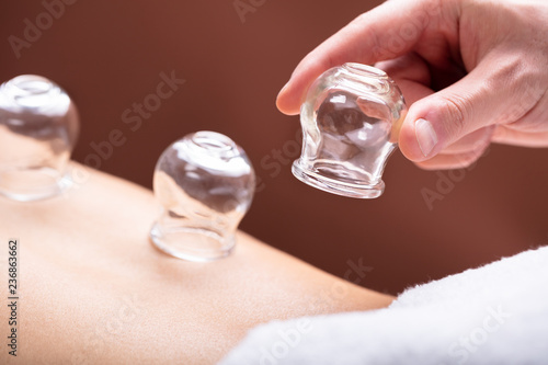 Therapist Placing Glass Cups On Woman's Back