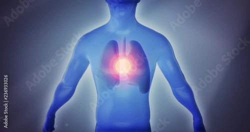 3D anatomy man suffering from lung disease, chest pain, asthma, emphysema, bronchitis, tuberculosis, pneumonia, cancer, infection or COPD on a dramatic background. Video a great for medical purposes.