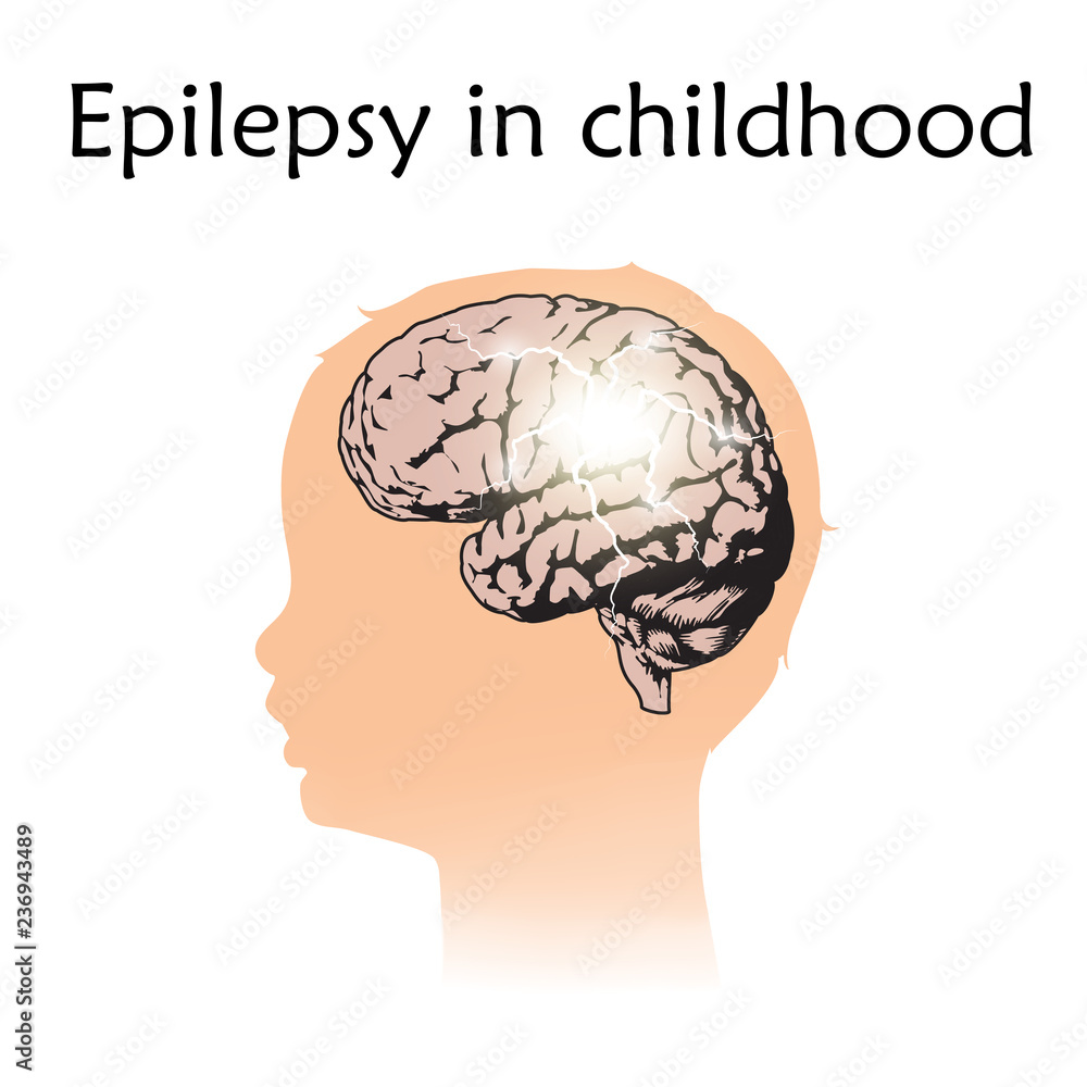 Epilepsy in infants, childhood. Vector medical illustration. Kid, baby, childhood. White background, silhouette of child head, anatomy flat image of brain, electrical discharge. Epilepsy in infants, childhood. Vector medical illustration. Kid, baby, childhood. White background, silhouette of child head, anatomy flat image of brain, electrical discharge.