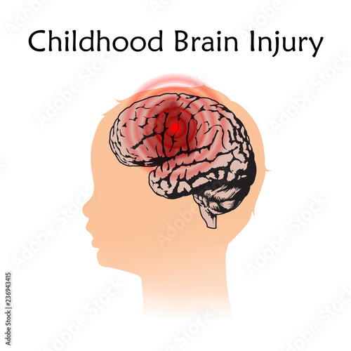 Braim injury in infants, childhood. Vector medical illustration. Kid, baby. White background, silhouette of child head, anatomy flat image of damaged human brain.