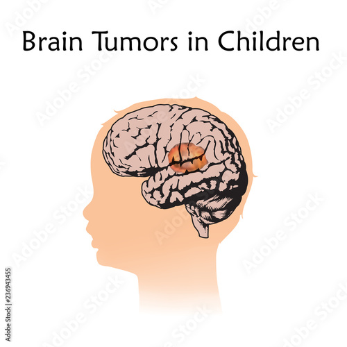 Brain tumors, cancer in infants, childhood. Vector medical illustration. Kid, baby, childhood. White background, silhouette of child head, anatomy flat image.