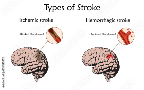 Stoke types poster, banner. Hemorrhagic, ischemic. Vector medical illustration. white background, anatomy flat image of damaged human brain, blocked and ruptured blood vessels.