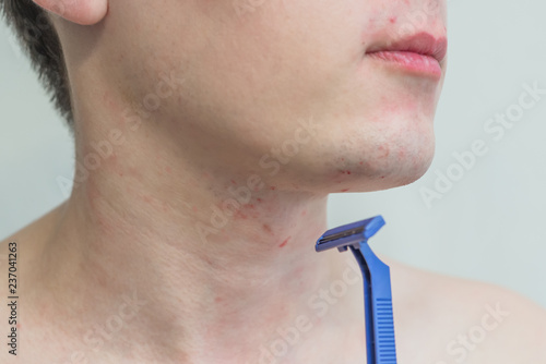 Foto Irritation after shaving