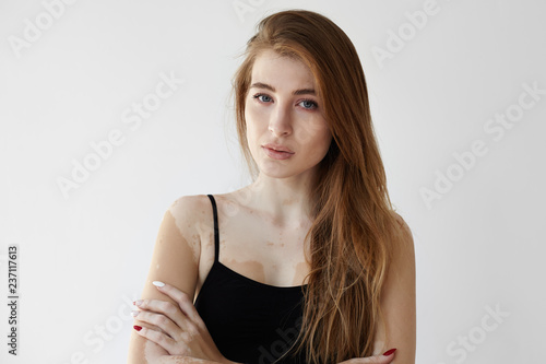 Portrait of beautiful confident young European woman with vitiligo posing in studio, dressed in black tank top, looking at camera with serious facial expression. Skin disorder, health and illness
