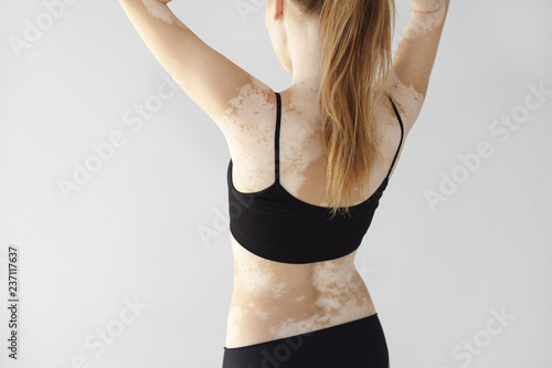 People, lifestyle, health, dermatology and auto immune disease concept. Rear view of unrecognizable woman with slim body wearing black underwear, doing hair, demonstrating white vitiligo spots photo