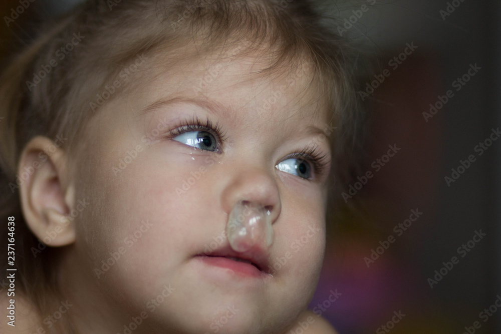 child with runny nose child with runny nose