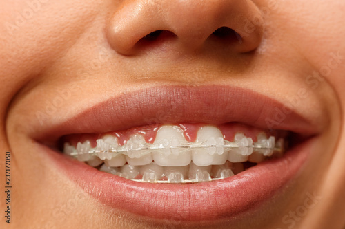 Beautiful young woman with teeth braces