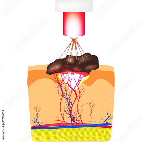 Removal of birthmarks, popiloma, wart laser. The structure of moles on the skin. Infographics. Vector illustration on isolated background.