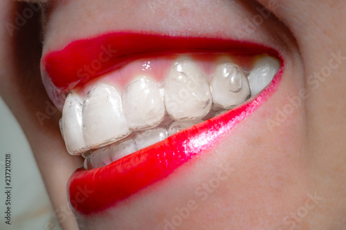 A woman's smiling mouth with red lips wearing invisible orthodontic aligners, side view